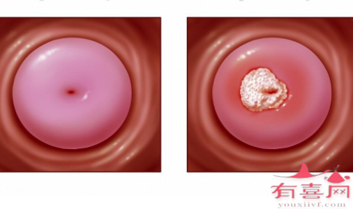 兰州捐卵微信群：宫颈囊肿会影响怀孕吗？